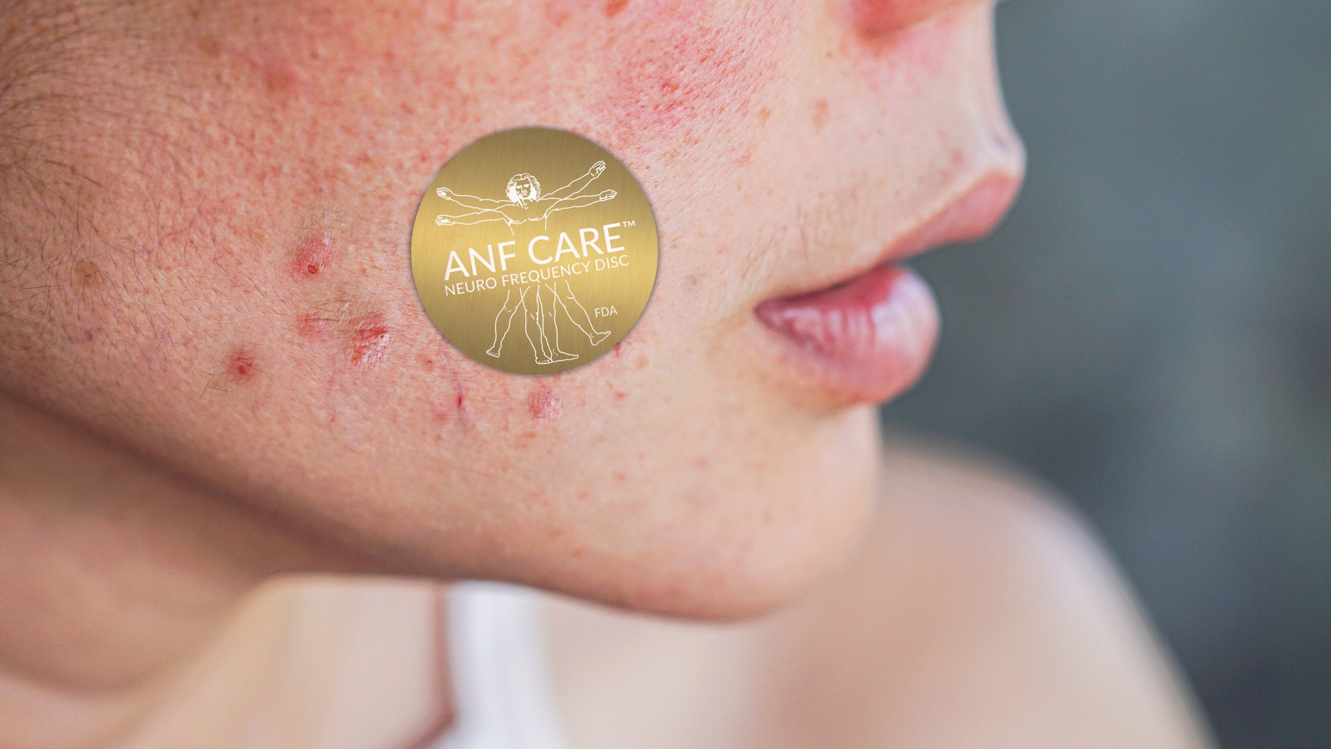 Acne Care Disc